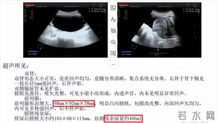 多名医生提醒：只要做过前列腺B超，中老年男性务必重视这3指标！