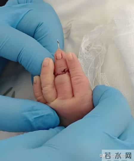 新生儿剪脐带竟剪断手指？父母崩溃，10天了还没说法