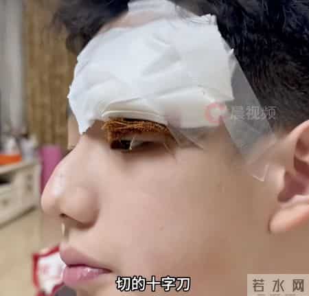 明星育儿“翻车”事件，挤痘痘真的会“要命”吗