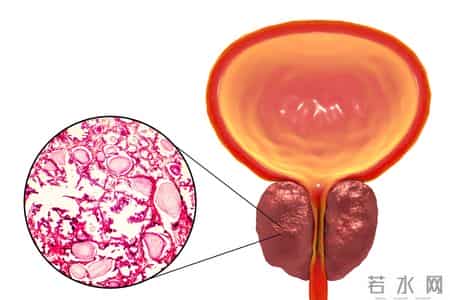 医生发现：天天走路的前列腺增生患者，不用几月，或迎来7变化