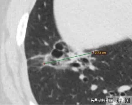 这种类型的肺癌，不仅充满风险，而且神秘莫测！