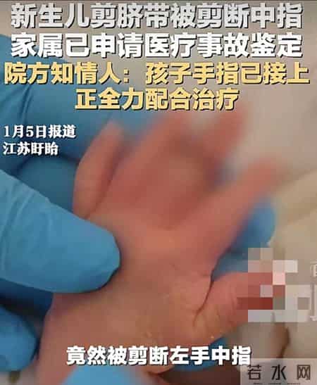 助产士剪脐带误剪新生儿手指，前期治疗结束，后续康复待观察