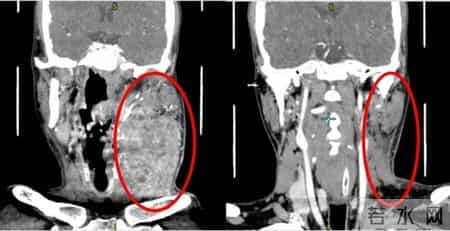 多学科协作，上海九院助33岁极晚期舌癌患者闯过生死关