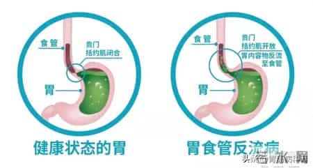 反流性食管炎防治指南：从检查、治疗到预防，一文掌握