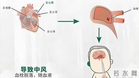房颤引发卒中 3 预警信号！忠告：出现一个就就医，别错过救治时机