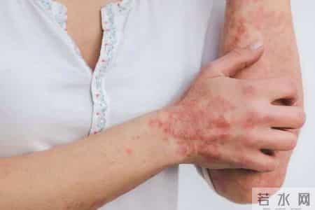 湿疹拖太久可能暗藏隐患，医生提醒：皮肤若出现这5种异常要警惕