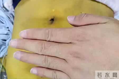 学医后才知道，肝癌最危险的信号，不是口干，而是出现4种症状