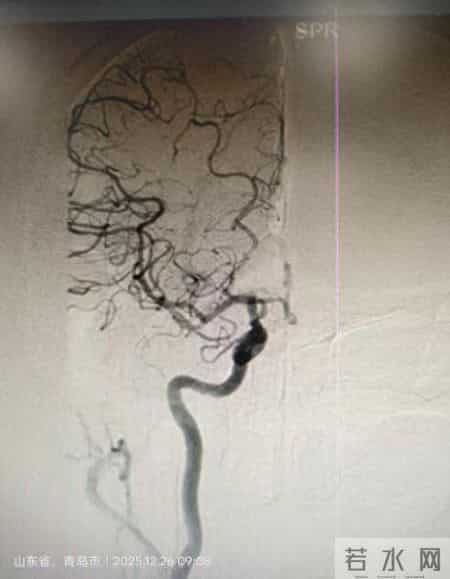 平度市第三医院神经内科力挽狂澜，成功抢救2名大脑中动脉急性闭塞患者