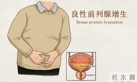 前列腺增生患者一旦活过78岁，大多出现如下3个症状，看看占几个