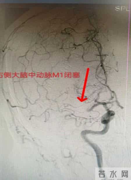 平度市第三医院神经内科力挽狂澜，成功抢救2名大脑中动脉急性闭塞患者