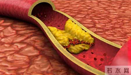 多名医生忠告：高血脂患者做完血脂四项检测，务必牢记 4 关键结果