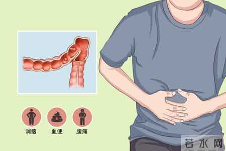 结直肠癌转移 5 危险信号！忠告：出现一个就就医，别耽误诊疗时机