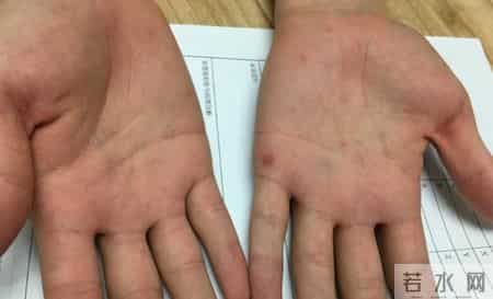 梅毒治愈后会复发吗？医生提醒：这2个习惯易诱发