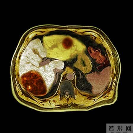 调查发现：65岁后常吃鸡蛋，患肝癌风险是不吃鸡蛋的数倍真的吗