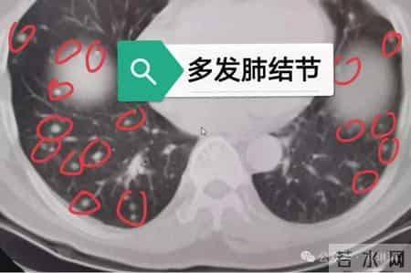 查出肺结节别乱吃！3种常见“养肺散结宝”，消掉双肺多发结节