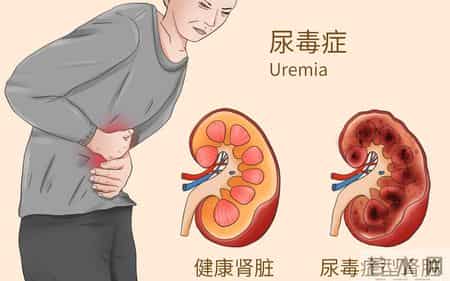 肾内科医生提醒：这5种不舒服其实是尿毒症，千万别忽视，速看