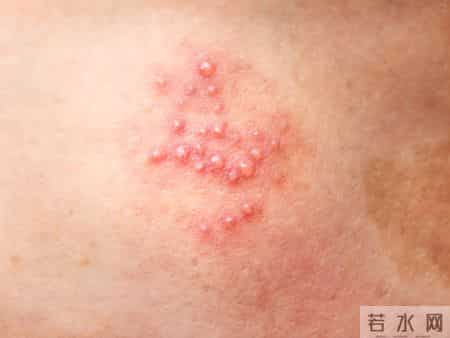 得了性病，身上这5个部位可能会长疹子，建议及时做这5个检查