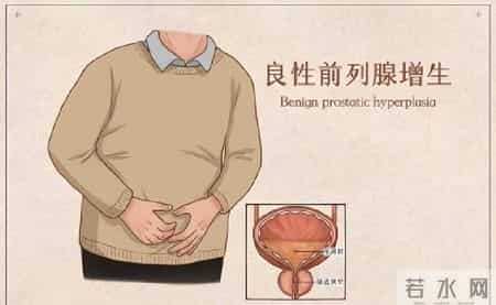 多名医生提醒：只要做过前列腺B超，中老年男性千万重视这3指标！