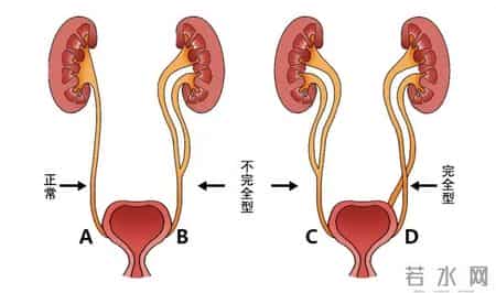 攻克难关 泌尿外科成功完成罕见重复肾移植