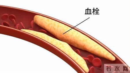 血栓“大户”被揪出，是肥肉的16倍！医生：经常吃，血管或扛不住