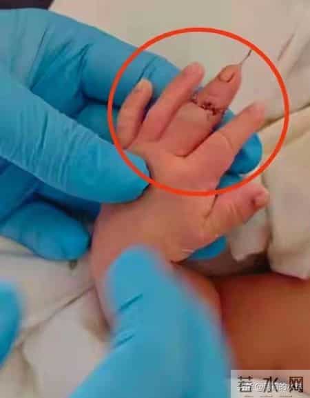 离谱！婴儿刚出生手指被当脐带剪断，全家心碎