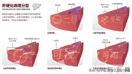 肝癌患者要想活得好、治得好,这4个大坑切记不能跳!