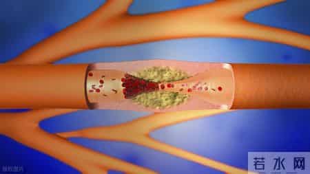 我国超2亿人查出颈动脉斑块！医生提醒：斑块可逆转，这5点很关键