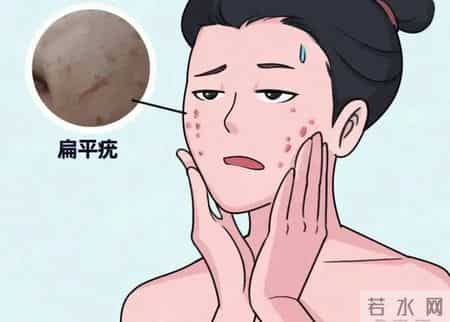 脸上、手背冒出的“小疙瘩”是啥？商丘专家详解扁平疣的防与治