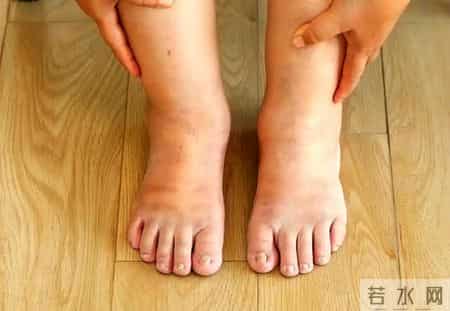 一周就肾衰竭！医生劝告：糖尿病患者若常出现4个不适，立即就医