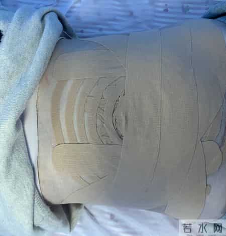 【特色治疗】“弹性铠甲”肌内效贴——对抗产后腰背痛、腹壁松弛、腹直肌分离的“小布贴”