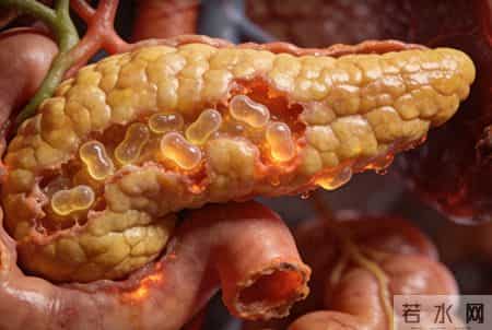 预防胰腺炎有哪些要点？温馨提醒：日常防护，牢记4个关键