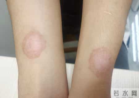 得了性病，身上这5个部位可能会长疹子，建议及时做这5个检查