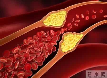 医生发现：经常吸烟的高血脂患者，不用很久，身体或有几大坏处