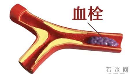 血栓和喝水有关？研究发现：越喜欢睡前喝水的老人，越容易有血栓