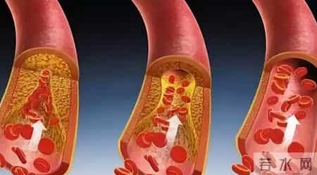 发现：蒲公英茶可在一天内溶解血栓扩张血管，是真的吗？听分析