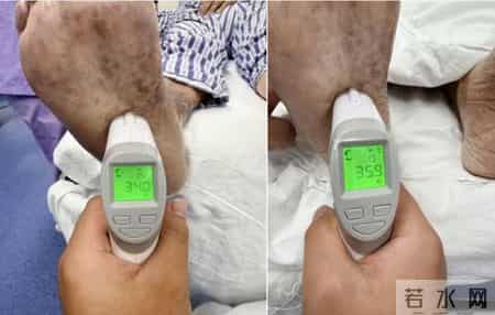 腰部一针，“解冻”寒腿！重医附二院率先开展射频消融术治疗复杂性下肢缺血