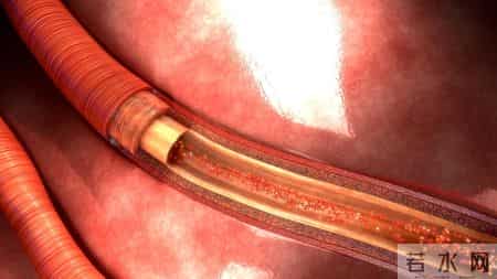 男子因脑梗不幸走了！提醒：天冷宁愿在家打牌，也别干这2事！