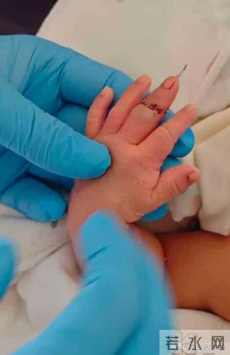 新生儿剪脐带竟剪断手指？父母崩溃，10天了还没说法