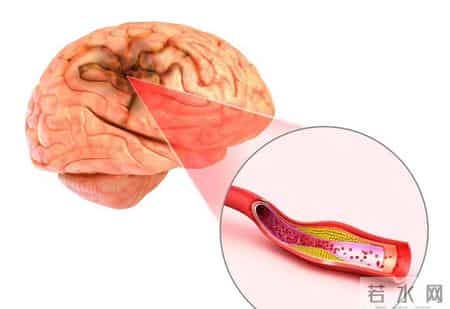 女子因脑梗不幸走了！医生：天冷宁愿在家打牌，也别干这些事！
