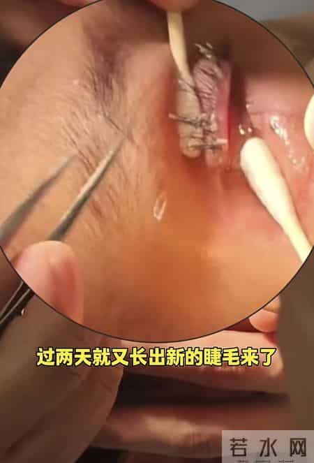 520胶水溅进孩子眼睛，妈妈30分钟救娃视力，医生：回家吧