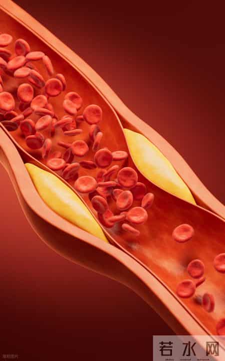 我国超2亿人查出颈动脉斑块！医生提醒：斑块可逆转，这5点很关键