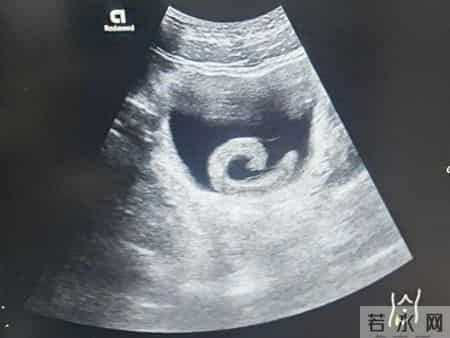 23岁男子网购5cm水蛭塞进尿道致剧烈疼痛、排尿困难