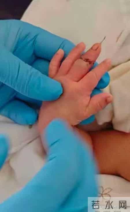 惊！剪脐带竟成剪手指！妈妈痛哭：谁赔我孩子的未来？