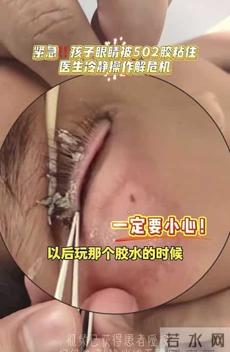 520胶水溅进孩子眼睛，妈妈30分钟救娃视力，医生：回家吧