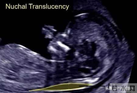 NT提示鼻骨缺失，怎么办？