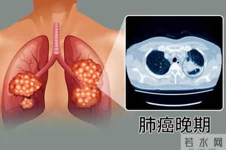 肺癌去世的人越来越多！早期无症状，专家：戒烟是重要干预因素