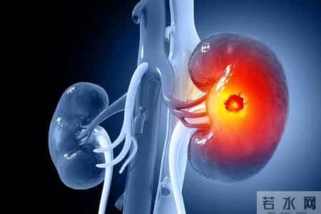 医生提醒：肾衰竭早期不是腰痛，而是身体出现5种异常，一定留意
