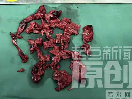 医生从濒死患者动脉掏血栓如同掏碎肉，因为严重的肺动脉栓塞，导致血氧极低无法自主呼吸