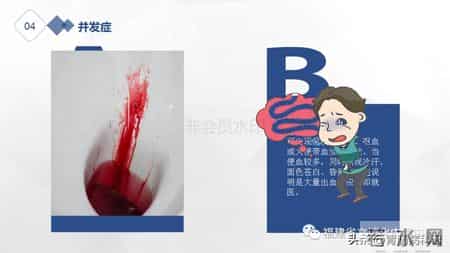 结肠息肉切除术后，这些要点需谨记！