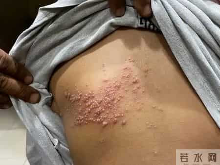 人不会平白无故患带状疱疹？医生：患带状疱疹，或有5个隐藏原因